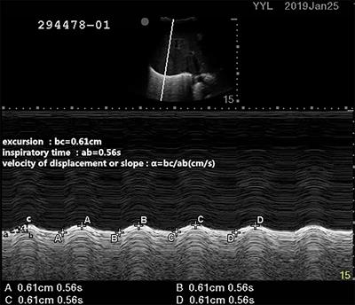 Predictive Value of Diaphragmatic Ultrasonography for the Weaning Outcome in Mechanically Ventilated Children Aged 1–3 Years